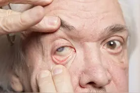 青光眼是什么？图片