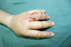 手指被小龙虾刺伤，竟差点截肢！要谨慎处理伤口，切莫大意图片