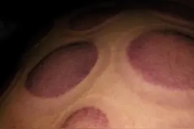 刺血拔罐的效果出来了图片