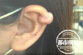 女子打完耳洞后，竟长了两个“肉球”！医生紧急提醒图片