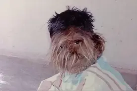 印度17岁男孩患狼人综合症，浑身长满毛发，仿佛“狼人”图片