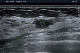 乳腺结节微创旋切，我的一位乳腺结节患者治疗过程图片