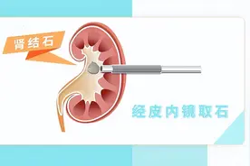 体检发现肾结石需要治疗吗？肾结石有哪些治疗方法？图片