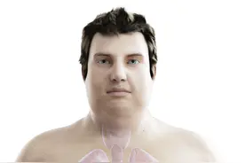 31岁女子颜值猛跌竟患库欣综合征，哪些人容易中招图片