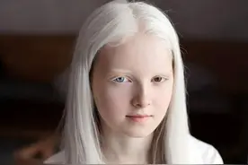 盘点8位患有白化病的模特：他们脆弱而纯粹的美就像一片雪花图片