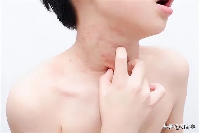 病毒性皮疹