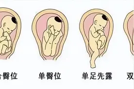 36周宝宝臀位换头位，我真的努力了图片