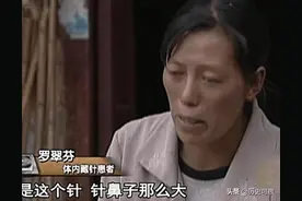 04年云南26岁女子尿血，发现体内有26根缝衣针，医生：1岁前扎的图片