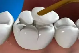 补牙材料掉了怎么办？紧急应对处理方法要知道，钱可不能白花了！图片