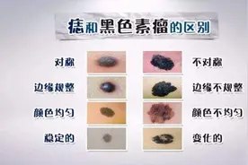你身上的痣会发生癌变吗？来浅测一下吧图片
