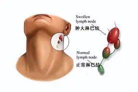 淋巴结为何会肿大？图片