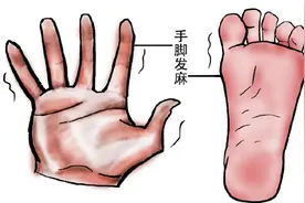 突然腿麻腿痛，小心“格林巴利”找上你图片