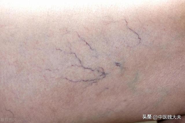 腿上有紫色的血纹是什么（再次提醒腿上有这种红血丝的人）