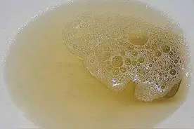 蛋白尿不好消，中医有一方，消水肿、降蛋白尿！图片