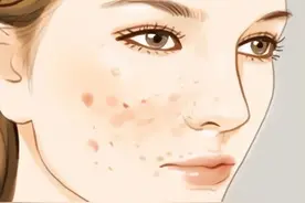 从祛痘到祛痘印、痘坑期，我们该如何对症下药？图片