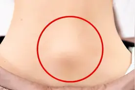 脖子后面凸一块是“富贵包”吗？如何消除？这3招简单又有效图片