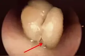 2岁宝宝吃下果核后咳嗽气喘，卡气管10天竟发芽图片