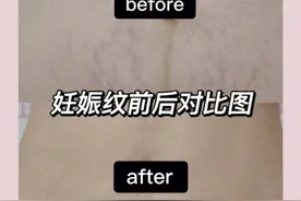 怀孕坚持用妊娠油反而越长越多？分享一下我的淡纹过程和方法吧图片