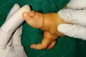 一百万人中仅有四例，男孩手掌分叉像“龙虾钳子”，还有救吗？图片