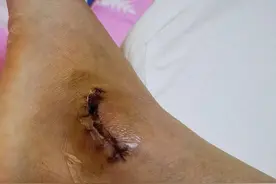 亲子运动会家长骨折 谁来赔？图片