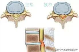腰椎管狭窄引发的腰腿痛、行走费力，怎么办？5种方法详尽告知图片