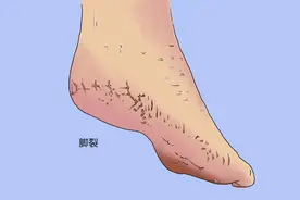 脚后跟总是干裂、掉皮状态，可能是身体发出的信号，别忽视了图片
