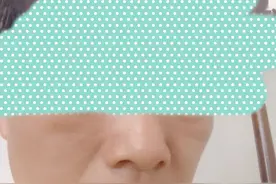 在家治黑疙瘩图片