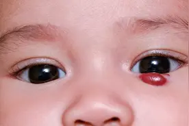 发现血管瘤，可以不用治？血管瘤有哪些类型，该怎么治疗？图片