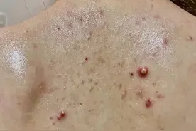 根除痘痘就一招！居家洗洗痘痘秒没！粗糙后背摸着滑溜溜！图片