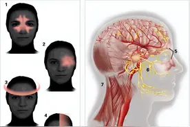 神经性头痛的症状和治疗方法图片