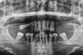 种植医生告诉你种牙最详细的过程是怎样的，看完惊呼原来这么简单图片