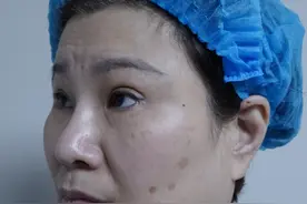 52岁女士大拉皮实录，切口长达10cm，时长5小时，术后“换脸”图片