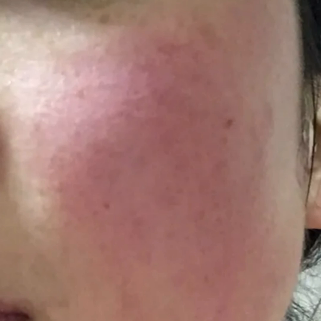 油烫伤脸怎么办