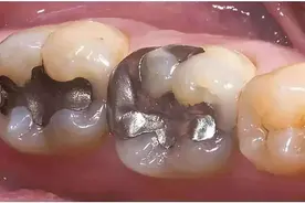 收藏！医生原来都是用这些材料，治疗烂牙的图片