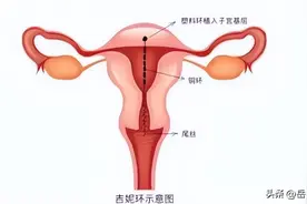吉曼环：子宫腺肌病巨大子宫患者的福音图片