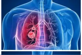 肺磨玻璃结节有时反倒是最安全的，为什么这么说呢？图片