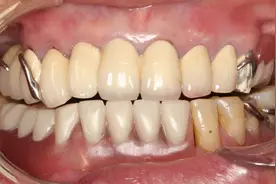 知名专家提醒：假牙不能戴太久，严重可导致嘴角开裂图片