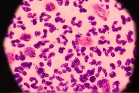 错把艾滋病误认为皮肤病？皮肤出现这5个表现，提醒你最好去检测图片