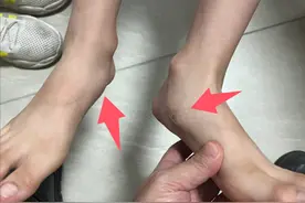 孩子跑步跑不动，不一定是懒，可能脚有“病”！图片