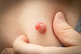 ​皮肤长“小肉球”是怎么回事，可以抠掉吗？如何正确消除图片