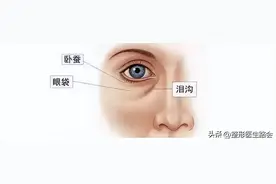 让人未老先衰的泪沟 用什么样的方式才能彻底摆平它图片