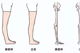 你有膝过伸吗？来看看到底怎么回事吧图片