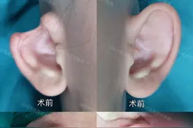 男子情场失意，“耳垂”也遭殃，皮瓣转移法还他一个完整耳朵！图片