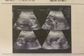 国内外罕见！山东大学齐鲁医院产科成功实施四胞胎延迟分娩图片