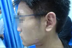 银屑病（牛皮癣）三十天干干净净图片