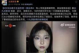 18岁女孩天生蓝色瞳孔，心理健康引发关注图片