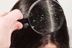 明明刚洗完头，头屑却依然“雪花飘飘”。到底该如何有效去屑呢？图片
