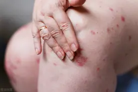 湖南中医药大学第二附属医院皮肤科专家李小莎带你了解皮肤过敏图片