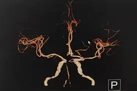 脑动脉狭窄到底需不需要放支架？听一听顶级脑血管专家团队的研究图片