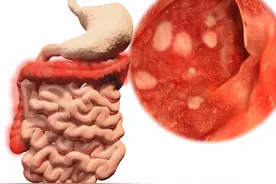 胃溃疡和十二指肠溃疡有何区别？医生：不妨从这3方面理解图片